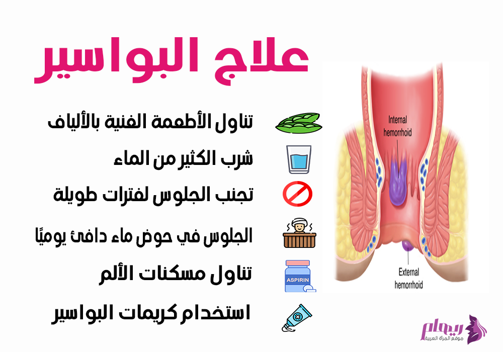 علاج البواسير