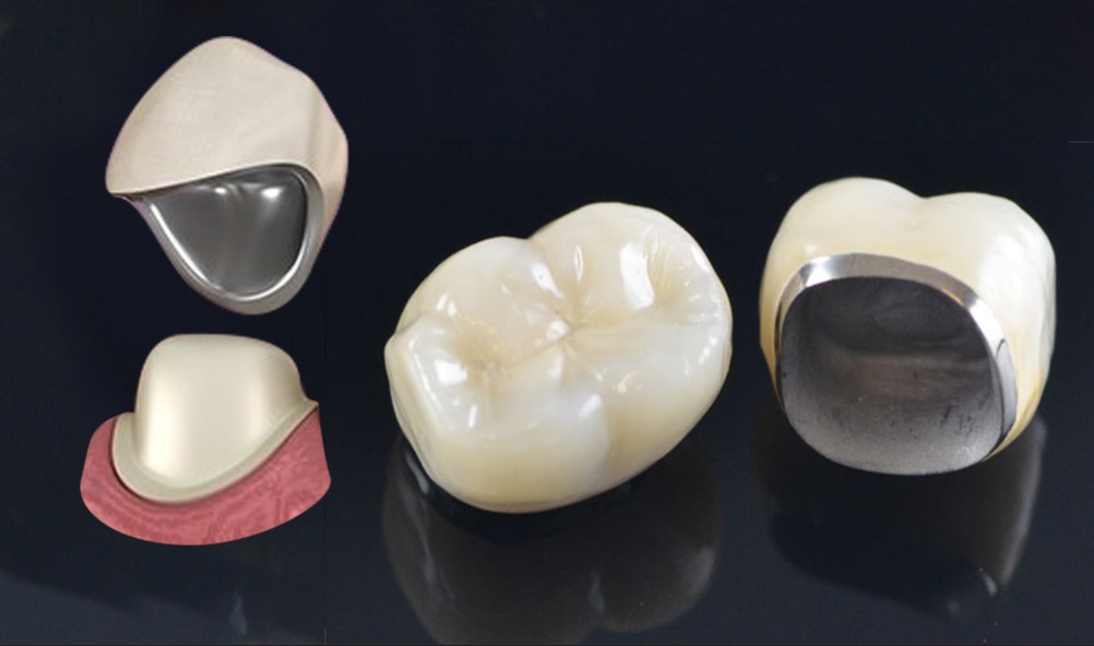 تركيبات الأسنان البورسلين